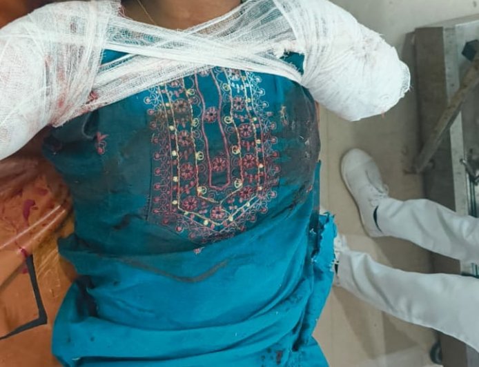 रेलवे ट्रैक पर रील बनाना पड़ा भारी, युवती के दोनों हाथ कटे